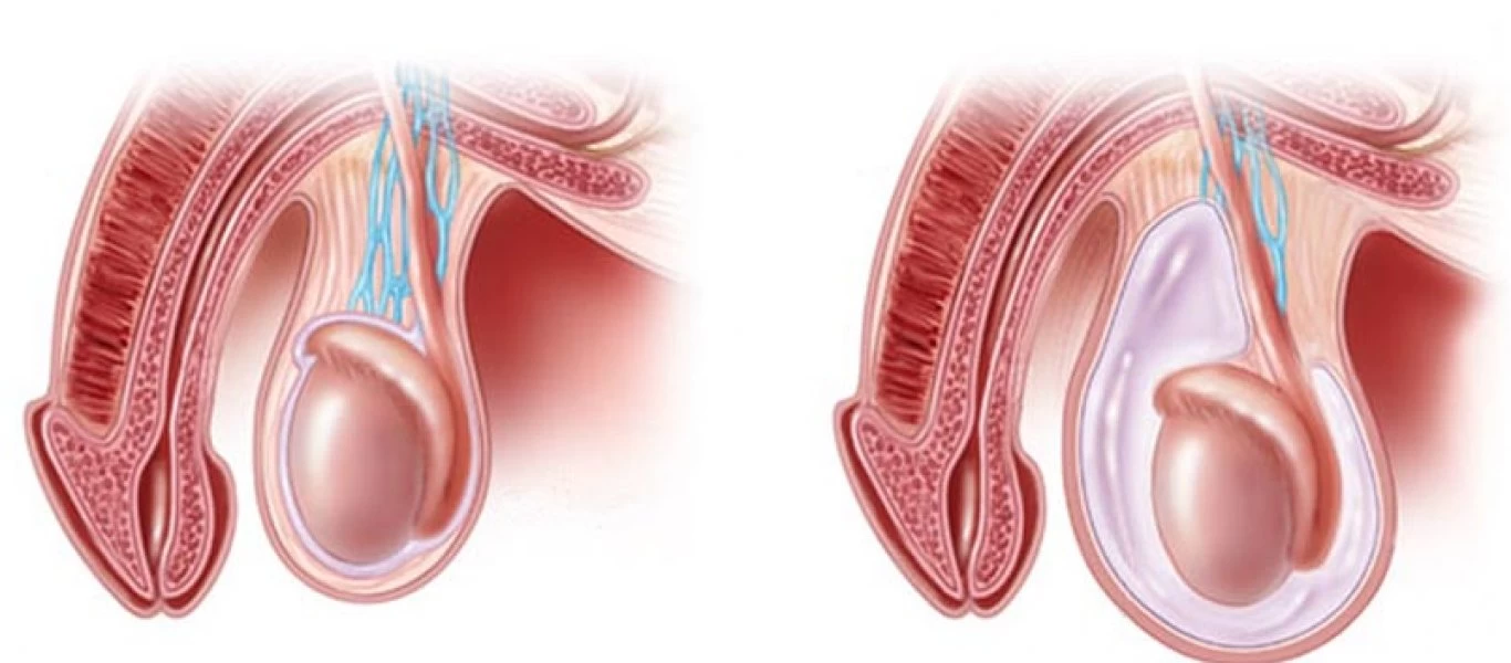 Πώς να αντιμετωπίσετε τον καρκίνο των όρχεων